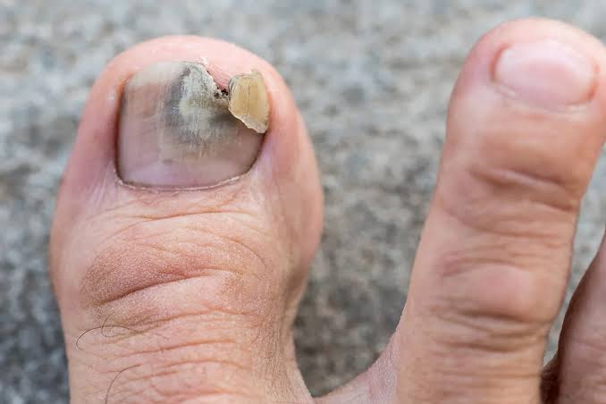 Toenail Fungus Signs: Practical Tips