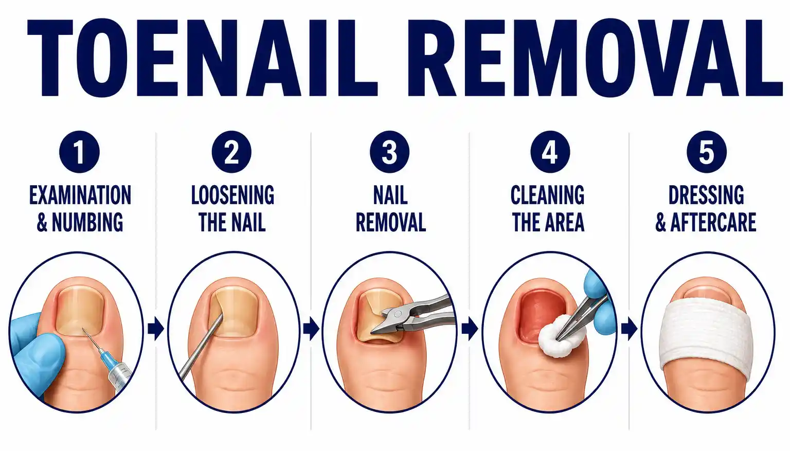 Early Toenail Fungus